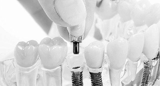 Implantate in Gebissmodell aus Acryl